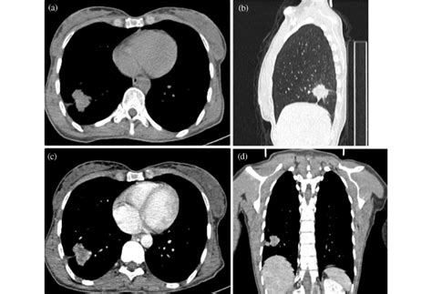 A 47-year-old woman, non-smoker, with a thoracic CT scan in the... | Download Scientific Diagram