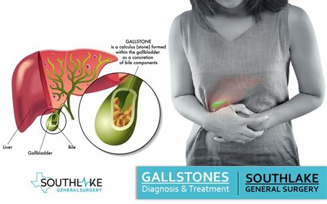 Gallstone Diagnosis and Treatment at Southlake General Surgery, Texas