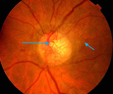 Diabetic retinopathy causes, symptoms, diagnosis, screening & treatment