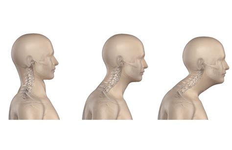 How To Correct Neck Posture at Enrique Ellinger blog