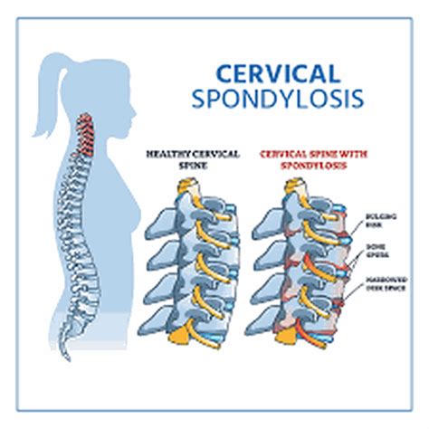 Causes of spondylosis - MEDizzy