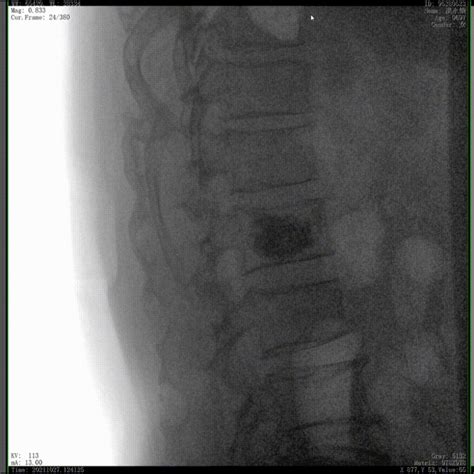 How can 3D mobile flat panel C-arm assist PVP surgery to effectively reduce cement leakage ...