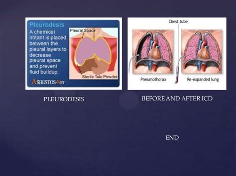 PNEUMOTHORAX fahad basheer