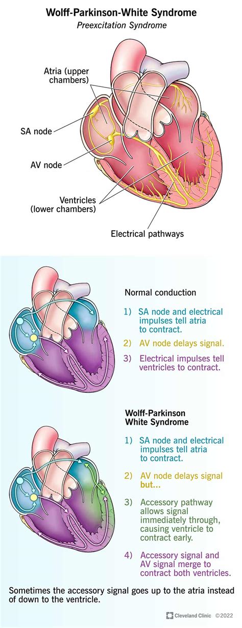 Wolff-Parkinson-White Syndrome