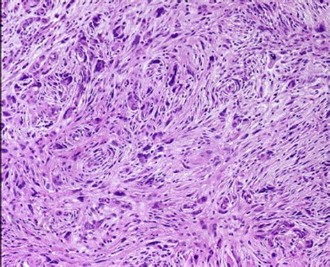 Pleomorphic Sarcoma of Bone (Malignant Fibrous Histiocytoma) - Pathology - Orthobullets