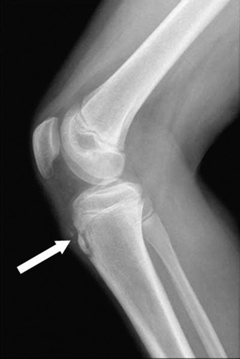 Lateral radiograph of the knee shows soft-tissue swelling and... | Download Scientific Diagram