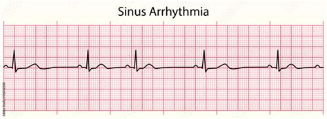 Sinus Arrhythmia