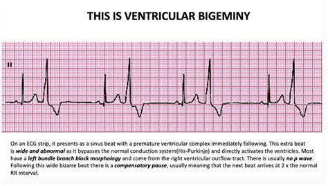 Ventricular Bigeminy - CARDIAC BOOTCAMP