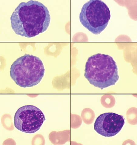 Circulating plasma cells in peripheral blood (cases 1, 2 and 3). | Download Scientific Diagram