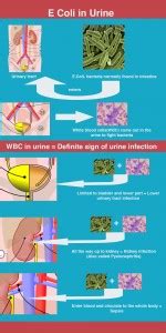 Have E Coli in urine? Here is what it means.