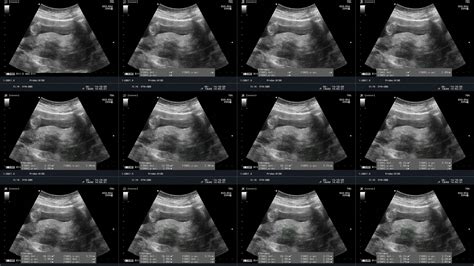 Uterine Fibroids Anatomy