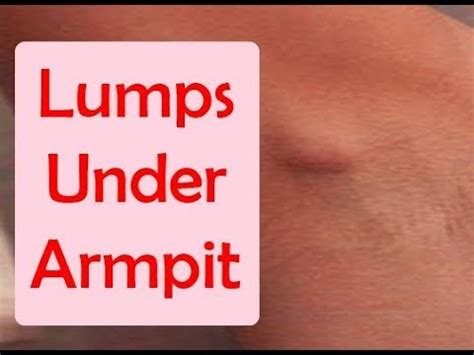 Home Remedies for Lumps Under Armpit | Lumps Under Armpit Treatment at Home - YouTube