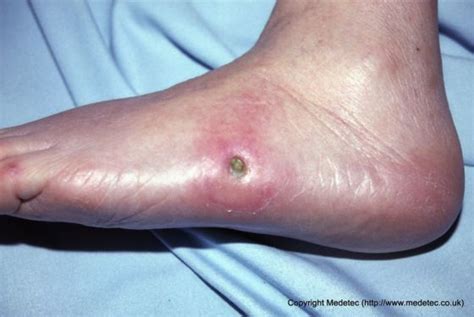 Diabetic Foot Ulcer Wound Description - DiabetesWalls