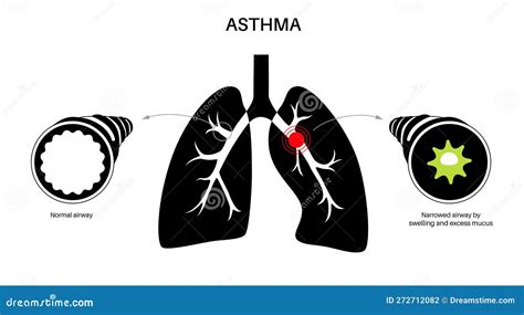 Asthma lung disease stock vector. Illustration of inflammation - 272712082