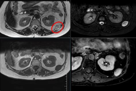 MRI images showing shwannoma of intercostal nerve on left with ...