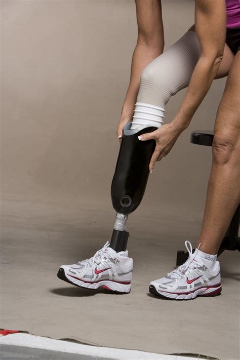 Artificial Leg Fitting | Leg prosthesis, Legs, Prosthetic leg