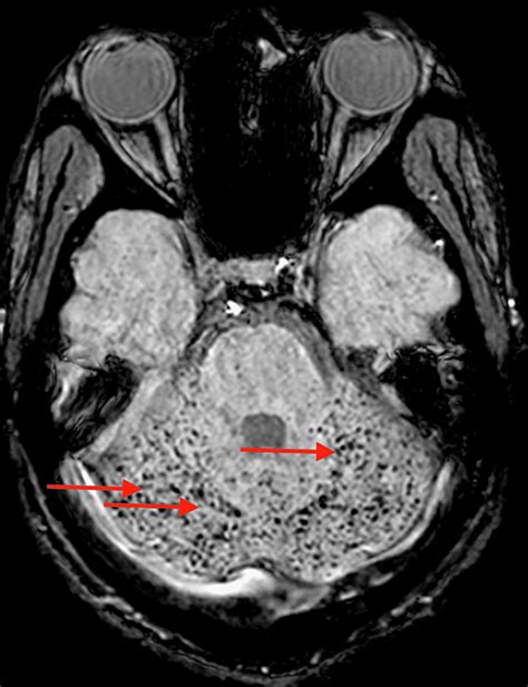 Cureus | Complete Neurologic Recovery of Cerebral Fat Embolism Syndrome in Sickle Cell Disease