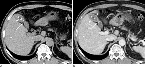 Segmental Adenomyomatosis of Gallbladder: CT Assessment of the Patterns of Cholecystolithiasis