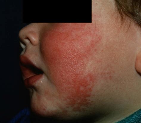 Fifth disease causes, incubation period, rash and fifth disease treatment