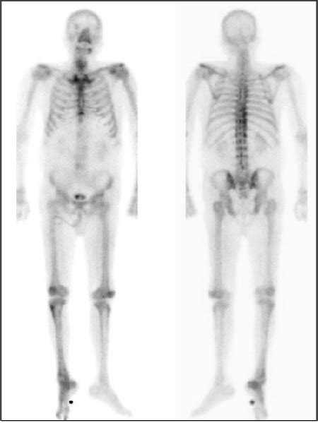 Bone scan shows no evidence of bone metastasis. | Download Scientific Diagram