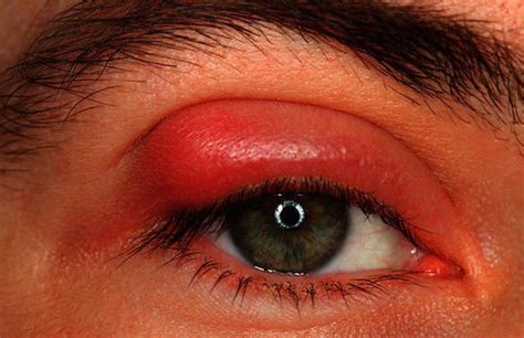 Pink Eye (conjunctivitis) - Symptoms and Treatment | Page 4 | Things Health