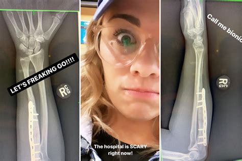 UFC stunner Paige VanZant shows off X-ray of healed broken arm injury ...