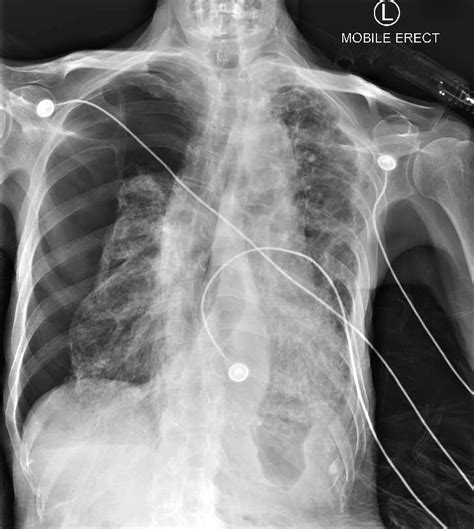 Tracheal Deviation | Chest X-Ray - MedSchool