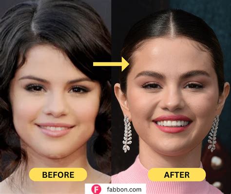 Did Selena Gomez Get Plastic Surgery ? | Fabbon