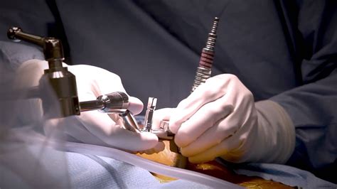 Minimally Invasive Laminectomy Surgery to Treat Lumbar Stenosis - MedStar Southern Maryland ...