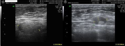 Ultrasound Axillary Imaging | IntechOpen