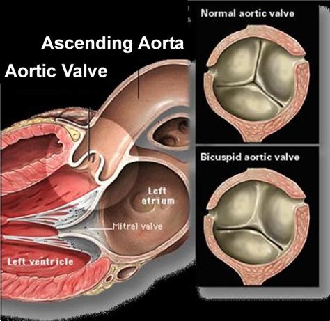 life after bicuspid aortic valve replacement - For A Beautiful Blogosphere Portrait Gallery