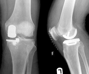 Partial Knee Replacement - Physiopedia