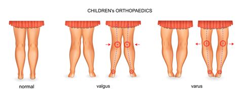 Varus vs Valgus Knee - Real Mina