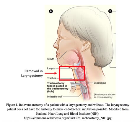 Shiley Pediatric Tracheostomy Tube Size Chart - Ponasa