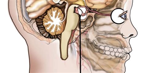 Craniopharyngioma Causes, Symptoms, Diagnoses And Treatment