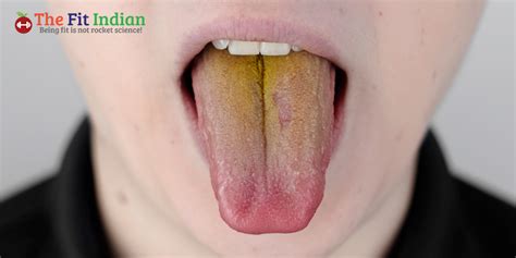 Dangers of Tongue Discoloration - Diseases Associated with Tongue Color - The Fit Indian