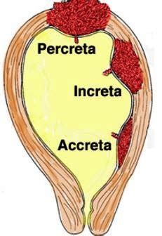 Placenta Accreta - What is, Symptoms, Risk Factors, Diagnosis