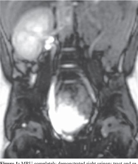 Figure 1 from THE DIAGNOSIS OF ECTOPIC URETER IN A PATIENT WITH RENAL INSUFFICIENCY BY MAGNETIC ...