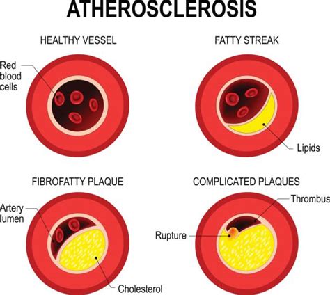 Calcified Arteries stock vectors - iStock