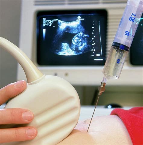 Amniocentesis Sampling With Needle And Ultrasound Photograph by Saturn Stills/science Photo ...