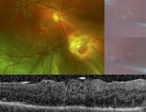 Tips for Successful Autologous Retinal Transplantation - Retina Today