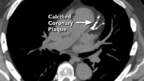 Coronary Artery Calcium Scoring (CAC) - Western Radiology Perth