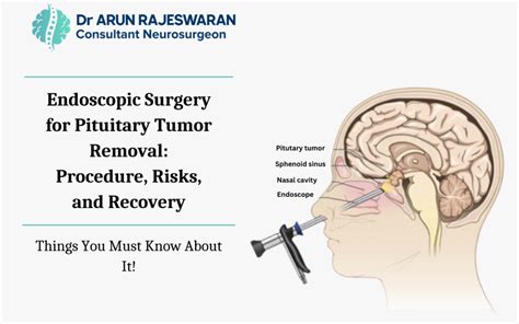 Endoscopic Surgery for Pituitary Tumor Removal: Procedure, Risks, and Recovery - drarunrajeswaran