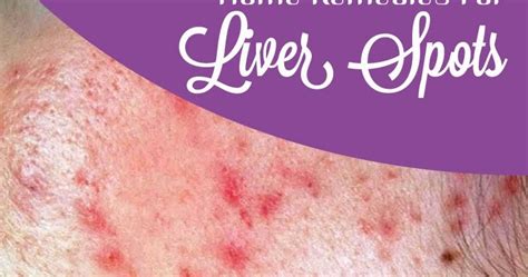 Home Remedies For Liver Spots | Tips Park