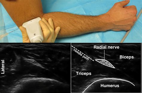 Forearm blocks — Highland EM Ultrasound Fueled pain management