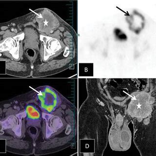 A 51-year-old male with complaints of abdominal distension and lower ...