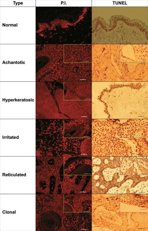 Different histopathological types of seborrheic keratosis stained for ...