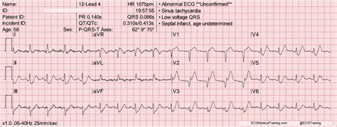 De Winter ST/T-Waves - ECG Medical Training