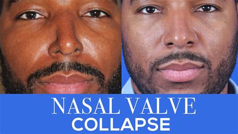 10+ Nasal Valve Collapse Surgery Before And After - SaphireAmmara