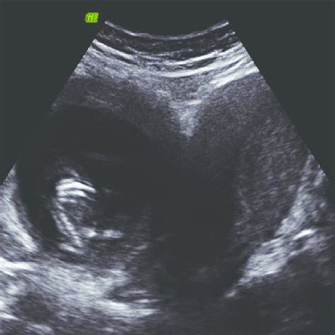 The gross appearance of the bicornuate uterus during surgery: (a)... | Download Scientific Diagram